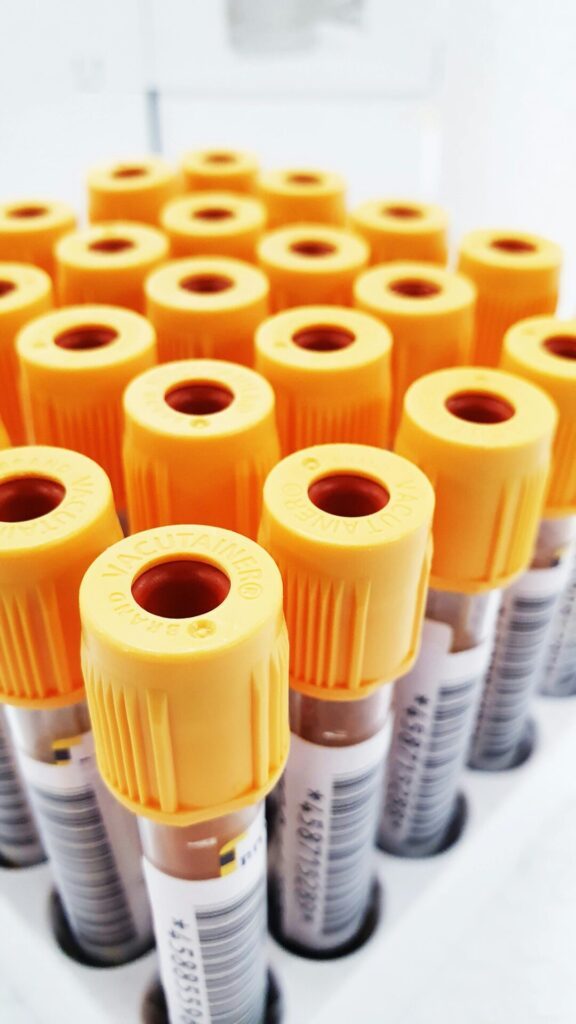 Row of yellow-capped blood collection tubes standing in a lab rack in a clinical setting.